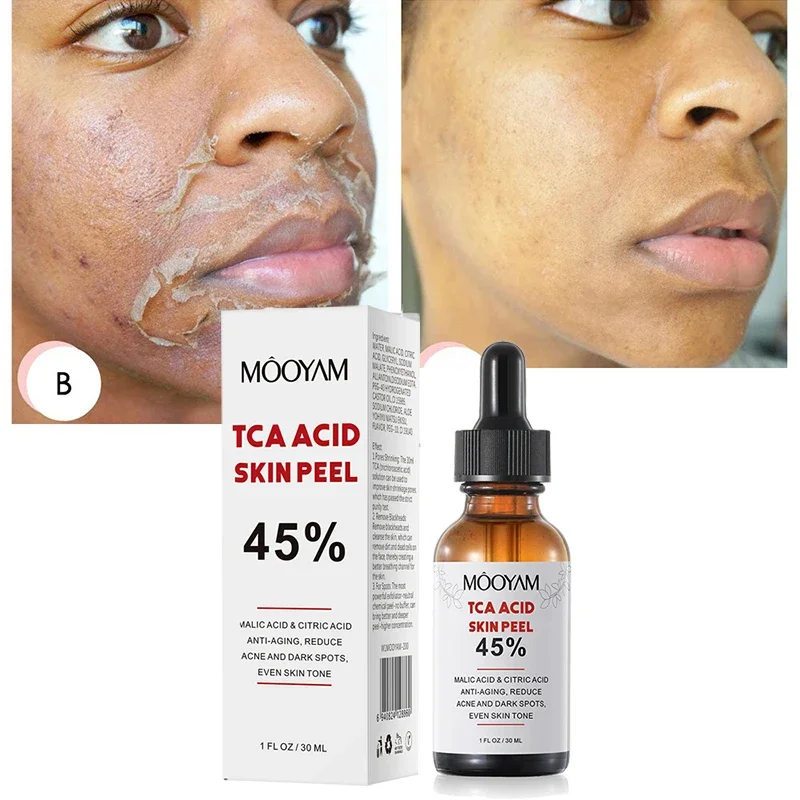 Chemical Peel Tca Peel Acid Peeling Acid 7-15 Days Delivered Skin Superforce Peeling Pigmentation Acne Scar BrightenSkin