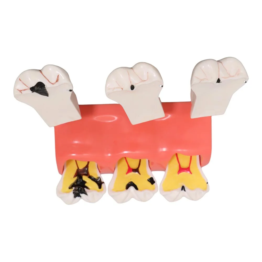 Dental Caries Disintegration Model Caries Development Model 3 Stage Quadruple Multiplication Dental Model