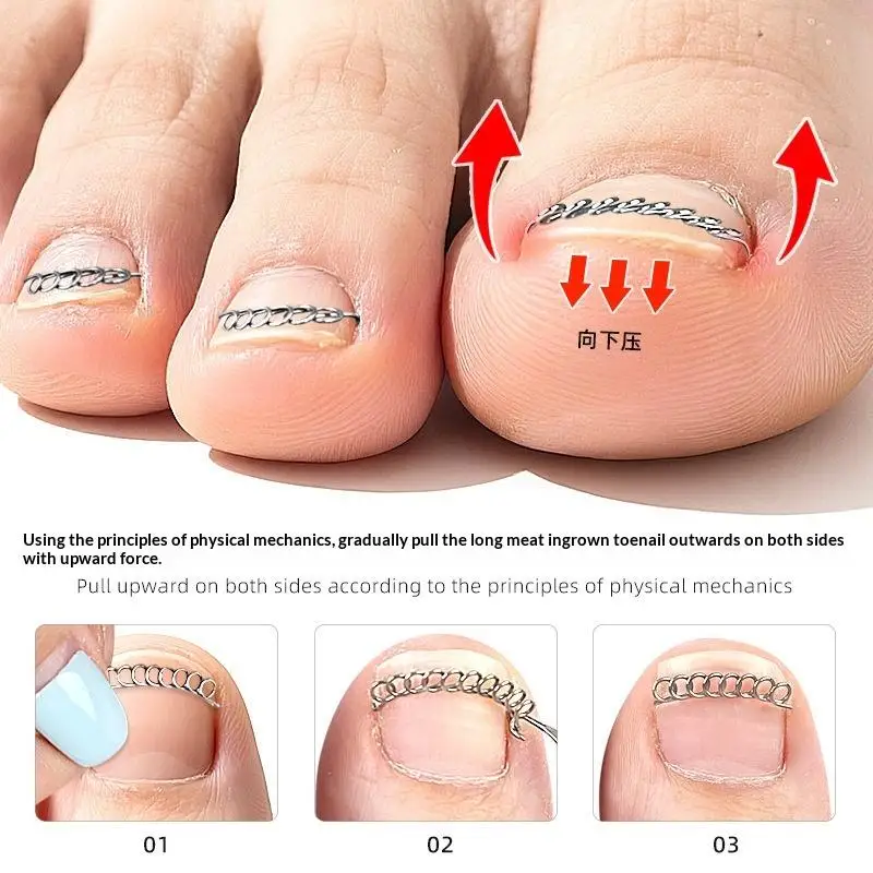 Ingrown Toenail Corrector No Piercing Painless Stainless Steel Safe Foot Care Tool for Home Pedicure Nail Repair