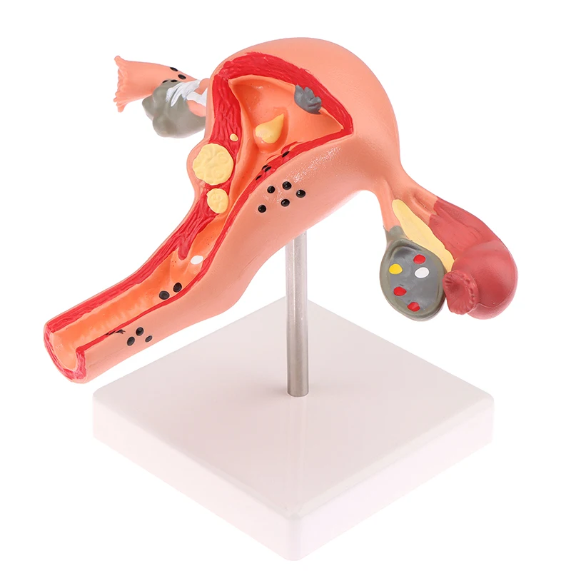 1Pcs Medical Props Model Pathological Uterus Ovary Anatomical Model Anatomy Cross Section Study Tool