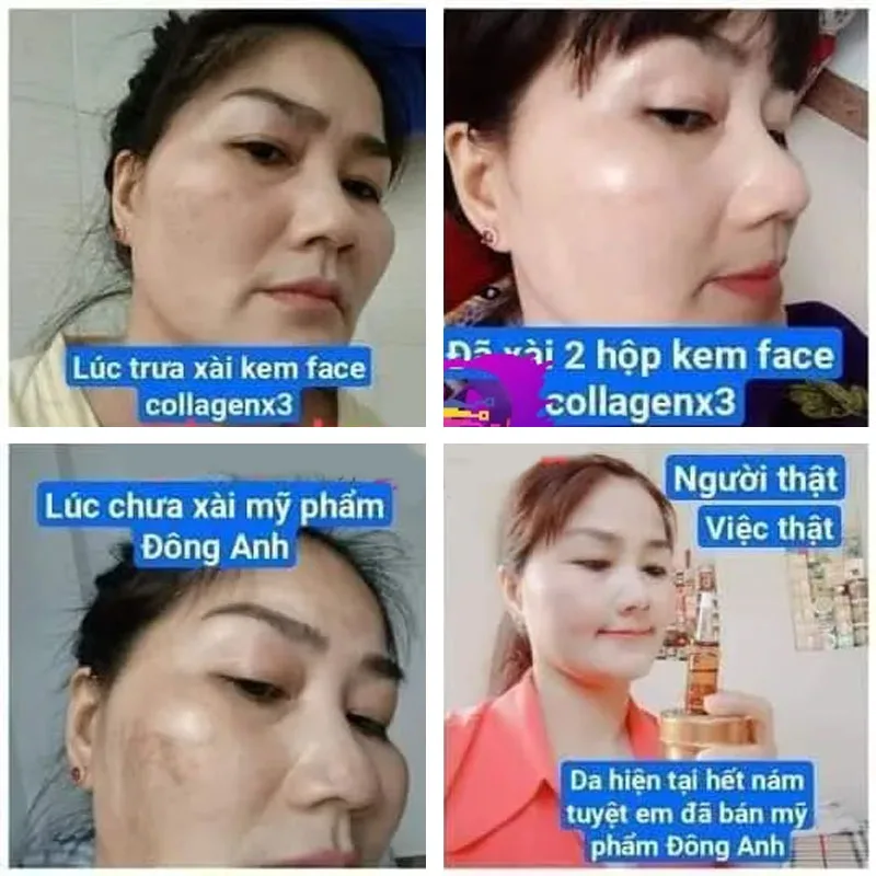 kem collagen X3 dưỡng trắng ngăn ngừa mụn nám mỹ phẩm đông anh phục hồi da hư tổn White Lightening 20g