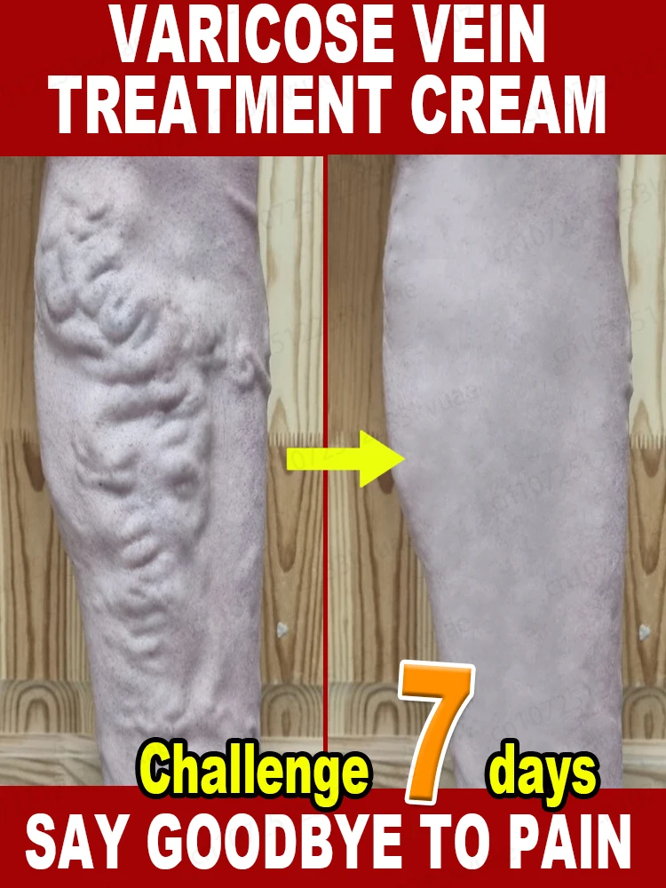 ᴇᴄʟᴀɪᴍ ʏᴏᴜʀ ʟᴇɢs' ʜᴇᴀʟᴛʜ, sᴀʏ ɢᴏᴏᴅʙʏᴇ ᴛᴏ ᴠᴀʀɪᴄᴏsᴇ ᴠᴇɪɴs ғᴏʀ ɢᴏᴏᴅ