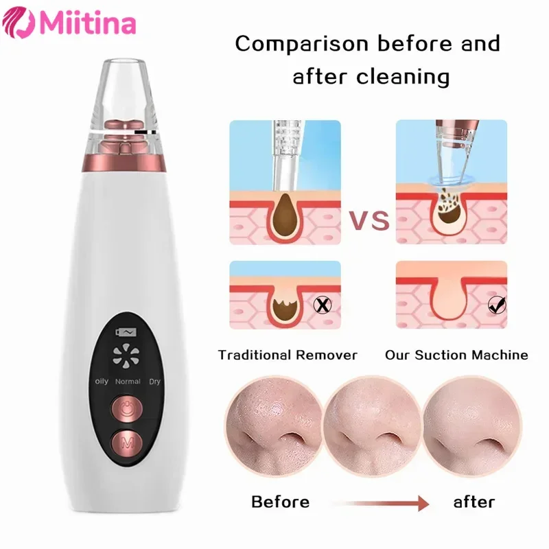 Miitina-remoção do cravo elétrico, limpador facial profundo, remoção do acne do vácuo, limpeza do poro, carregamento do usb