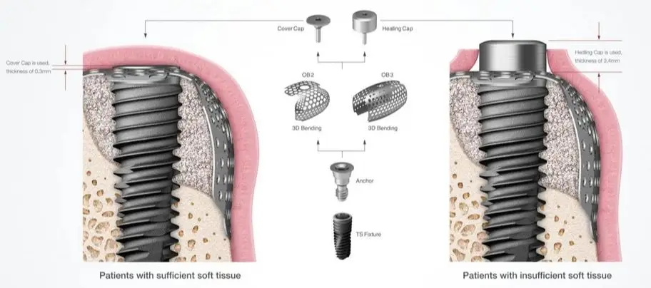 Dental GBR Titanium Mesh Bone Graft Dental Dish Membrane Plate Titanium Orthodontic Plates Flexible Grid