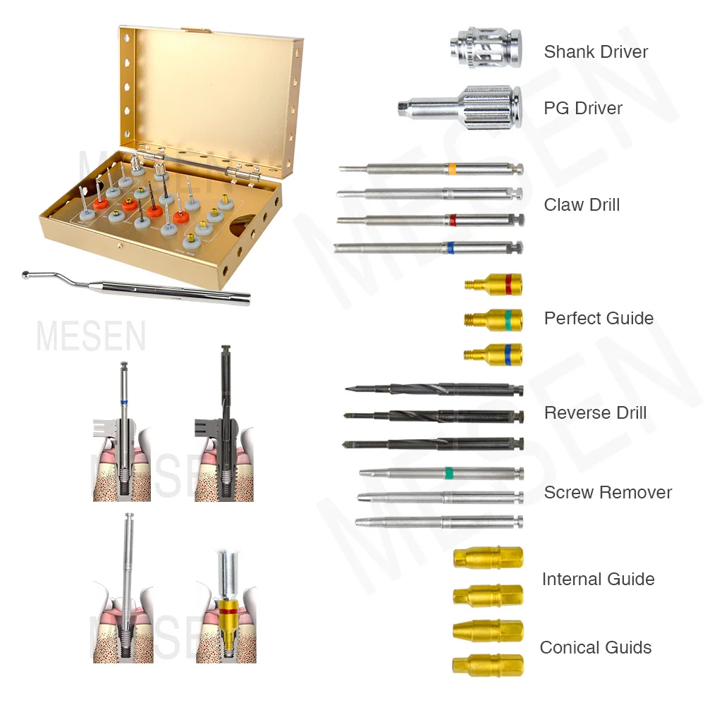 Dental Implant Removal Kit, Damaged Screw Extractor Set Dentistry Implanting Tools Lab Necessary