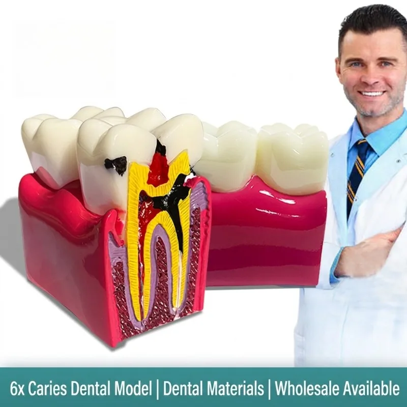 

Dental Exam Practice Pulp Cavity Tooth Model Root Canal Extracted Tooth with Cavity Preparation for Dental Students Training