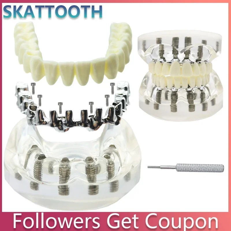 Dental Implant Model Transparent Upper Lower Jaw 6 Implants Overdenture Restoration Teeth with 6 Removable Screws Dental Demo