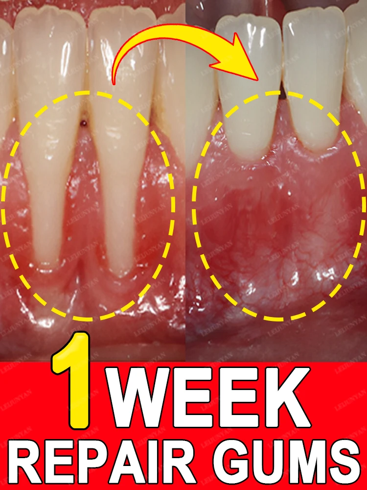 Repair damaged gums, relieve gum pain, strengthen gums, restore healthy gums! ! ! !