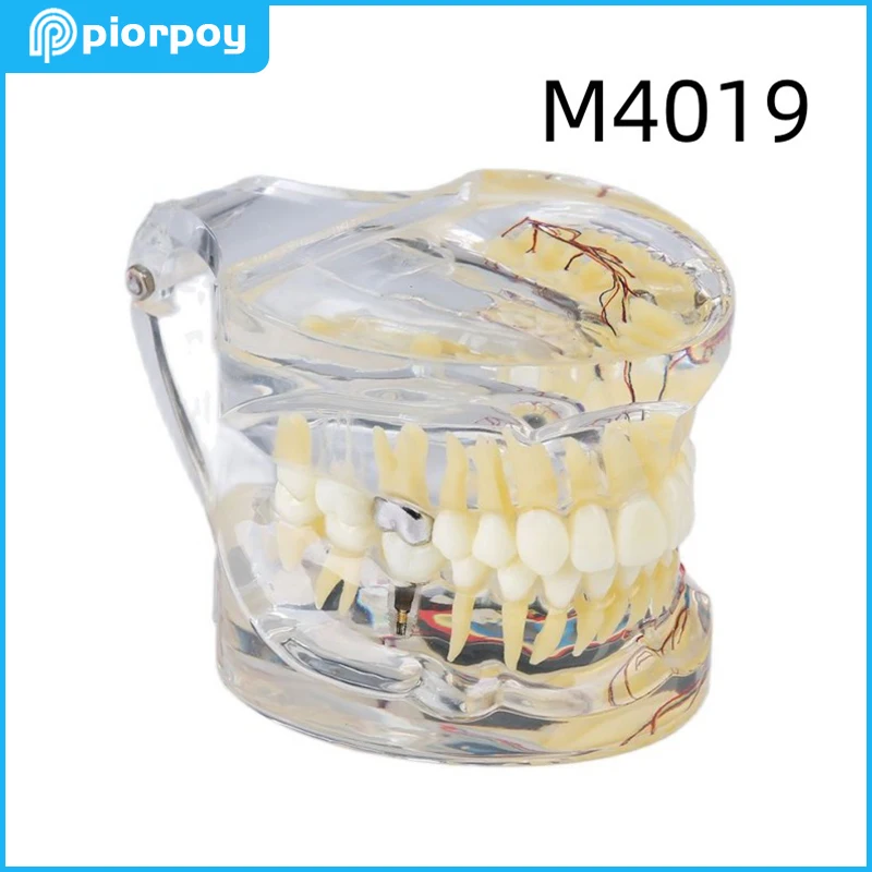 Dental Pathologies Teeth Model with Nerve for Demonstration Dentistry Education Teaching Models Students Practice Products M4019