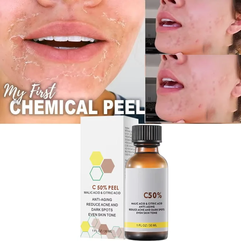 With Malic Acid And Citric Acid For Face Facial Peel 40% Peeling Serum Peeling Serum Chemical Peel Whitening Nourishing Essence