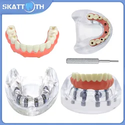 1Pc Dental Implant Model 6 Implant Overdenture Restoration Teeth Model Dentist Student Education Studying Typodont Implant Model