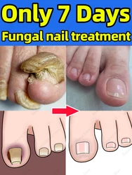 Solve all nails problems