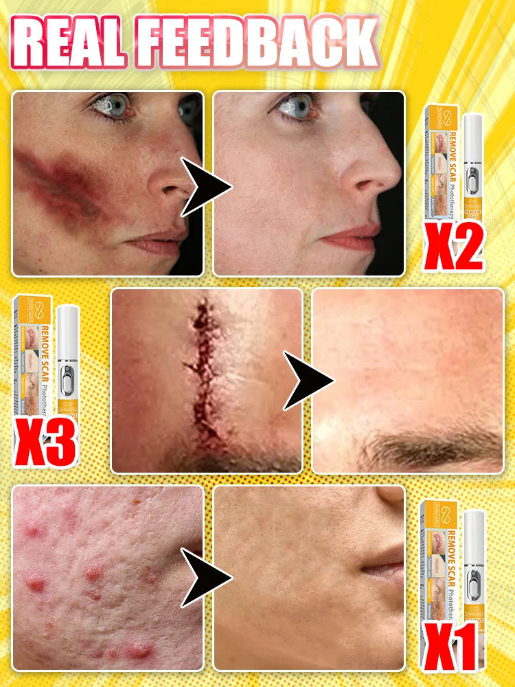 Dispositif laser de qualité médicale, économisez votre peau!