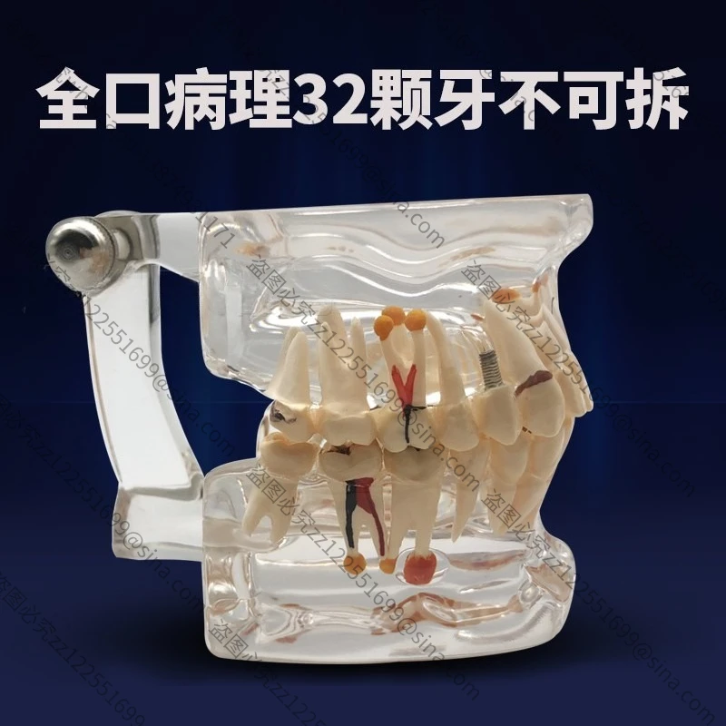 Suitable for Teaching Model Detachable Teaching Ready Denture Model Ornament