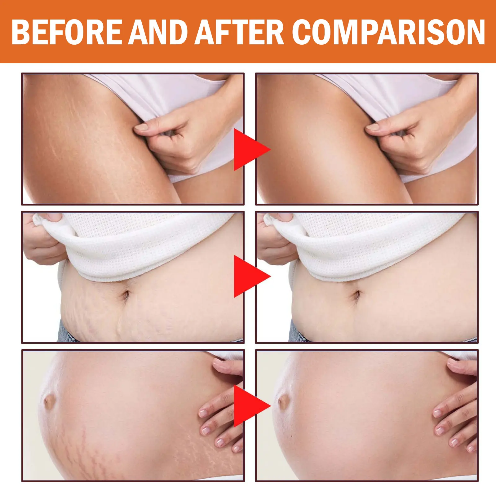 100g Stretch Marks Permanent Removal Cream Maternity Pregnant Women Pregnancy Anti-Winkle Smooth Repair Firming Skin Body Care