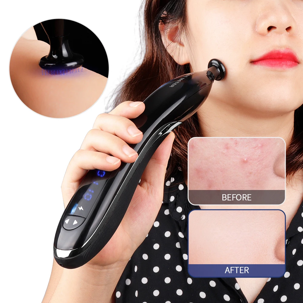 

Ozone Acne Treatment Machine Acne Removal Shrink Pores Skin Rejuvenation Plasma Pen For Face Lifting Skin Care Tool