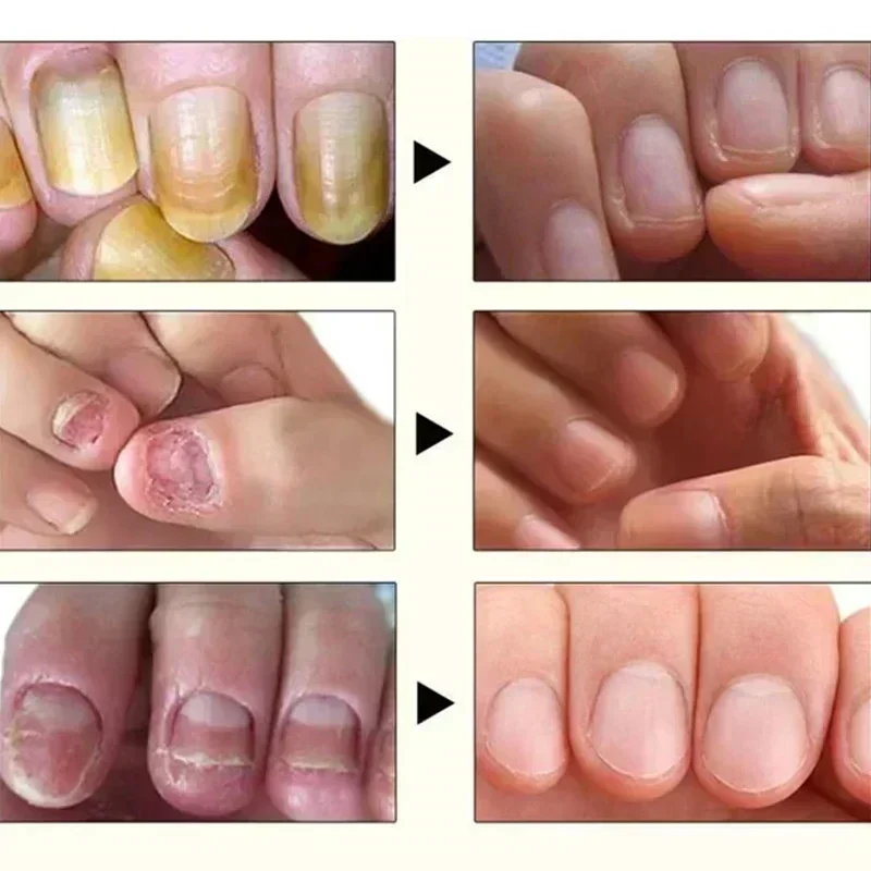 Traitement Antifongique des Ongles Incarnés, Soins des Pieds, Essence Anti betection, ParonyamieOnychomycose