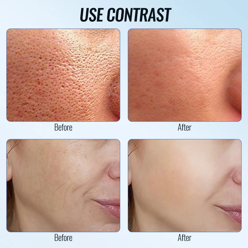 2025 Nuevo dispositivo de terapia de luz roja y azul: masajeador facial frío/caliente con vibración sónica para acné, arrugas y estiramiento de la piel