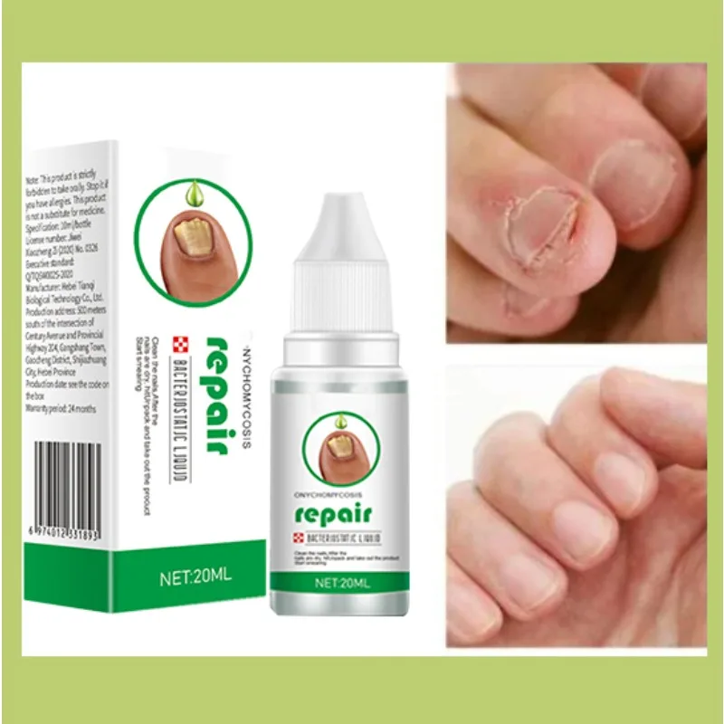 Beschermende huid Schimmel Nagel Behandeling Voetverzorging Essentie Nagel Voet Whitening Teen Nagel Schimmel Verwijdering Gel Anti Infectie Paronyc