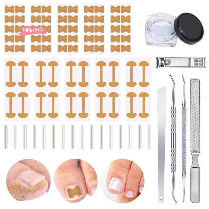 1 Set selbstklebende Zehennagelflicken für eingewachsene Zehennägel, Korrekturaufkleber, Fußkorrektur, Pediküre, Gesundheitswesen, Werkzeuge, Zehenbehandlungspads