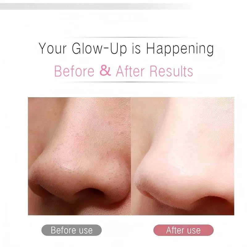 초음파 피부 세정기 및 각질 제거제 - 블랙헤드/여드름 제거를 위한 딥 포어 페이셜 클렌저, 이온 기술 페이셜 셔블