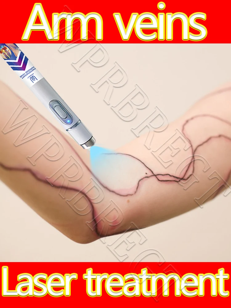

The new generation of varicose vein laser pointer