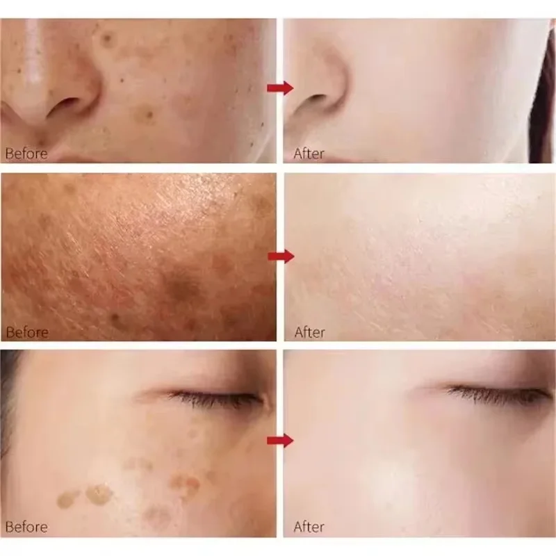 Turmeric Freckle Removing Whitening Essence Fade Pigmentation Melasma Dark Spots Corrector Repair Serum Korean Skin Care