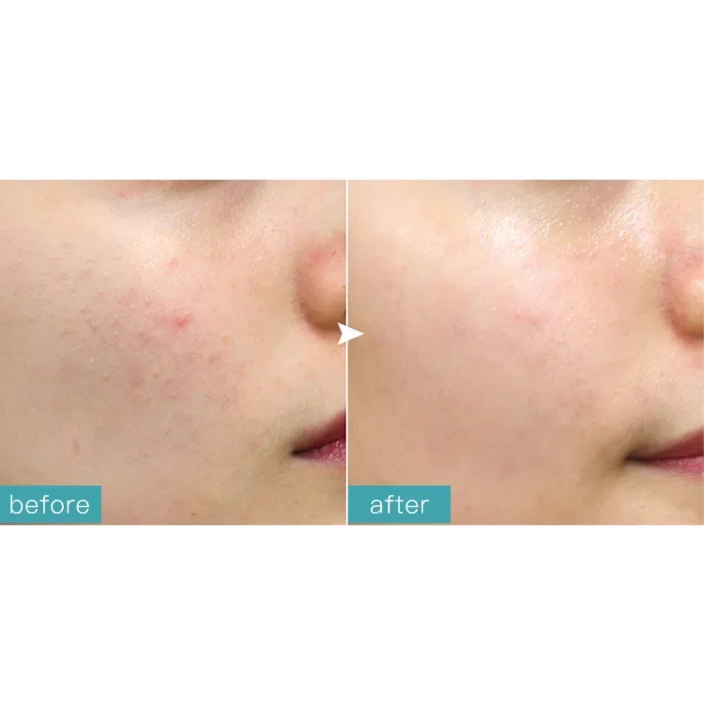 D18 oligopeptídeo purificar reparação soro clarificando óleo equilíbrio reparação facial desaparecer marcas de acne remover cravos coreia cuidados com a pele