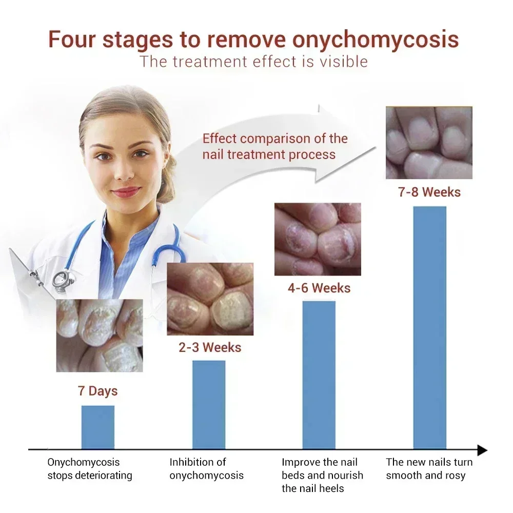 NewNail Fungus Tratamento, Toe Fungal Repair Products, Mão e pé cuidados remoção Gel, Anti Infection Onychomycosis Paronychi090