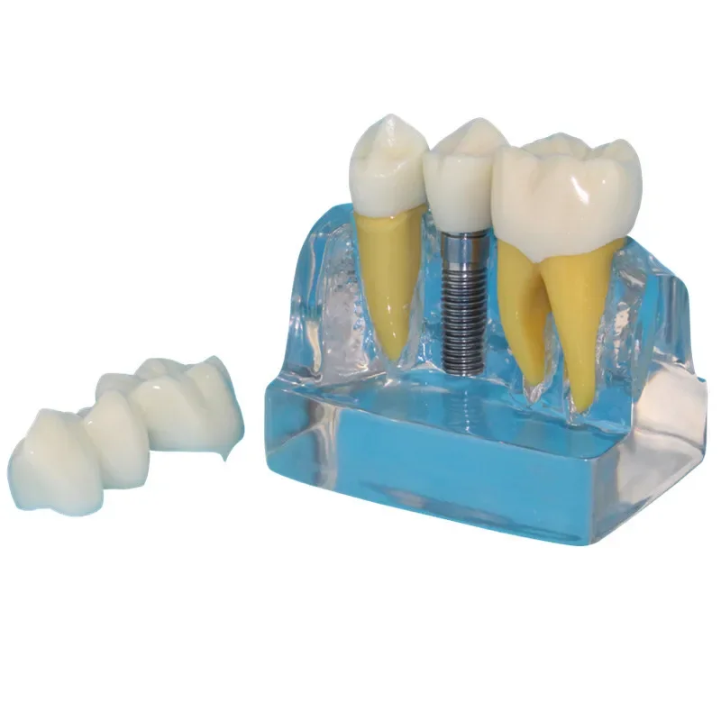 

Human Oral Dental Model, Transparent Tooth Model, Dental Implant Model