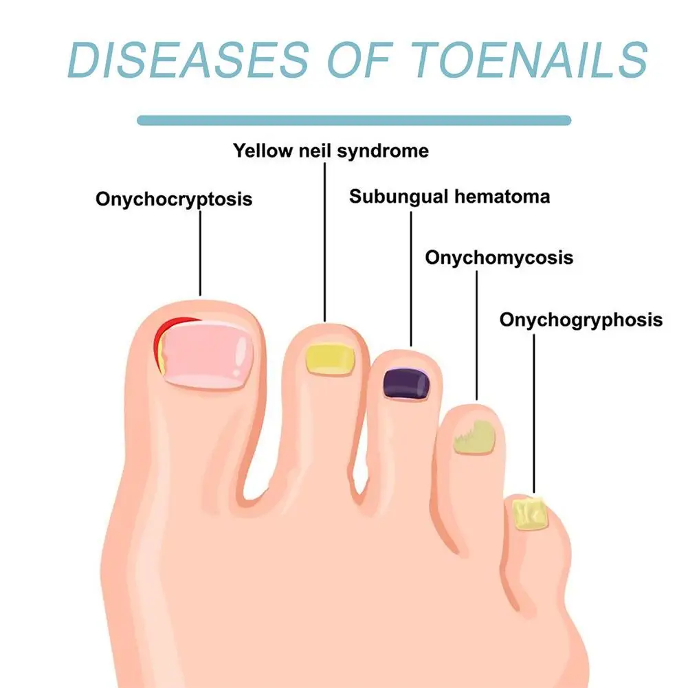 New Nail Fungus Laser Treatment Device Fingernails Toenails Onychomycosis Therapy Cure Machine Unisex Foot Care Tool