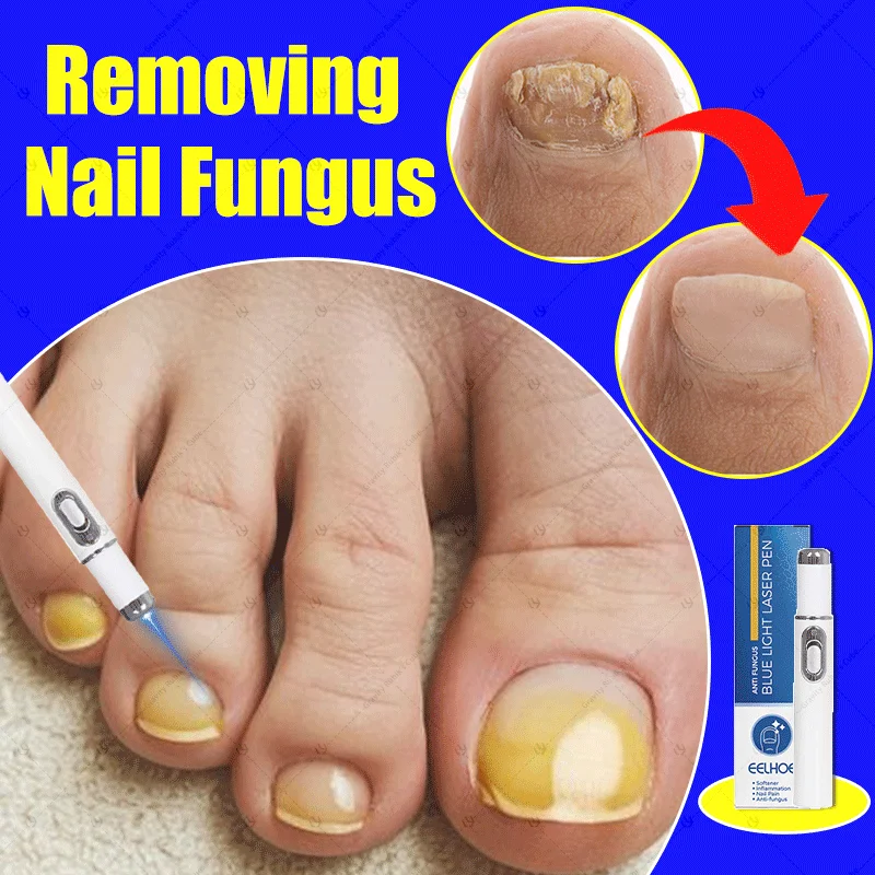 เล็บเลเซอร์สีน้ำเงิน