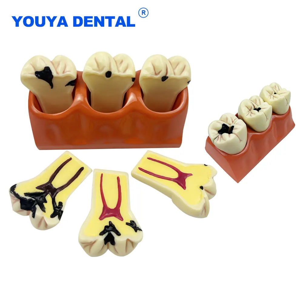 Dental Caries Model 4Times Disease Standard Teeth Model Demonstration for Teaching Research Studying Dentist Comparation