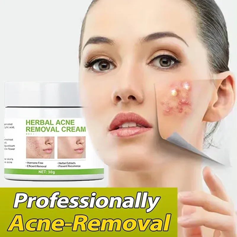 Effective Acne Removal Comfortable Acne-removing Liquid Improve Acne Convenient Facial Repair Solution Skin Care Products Gentle