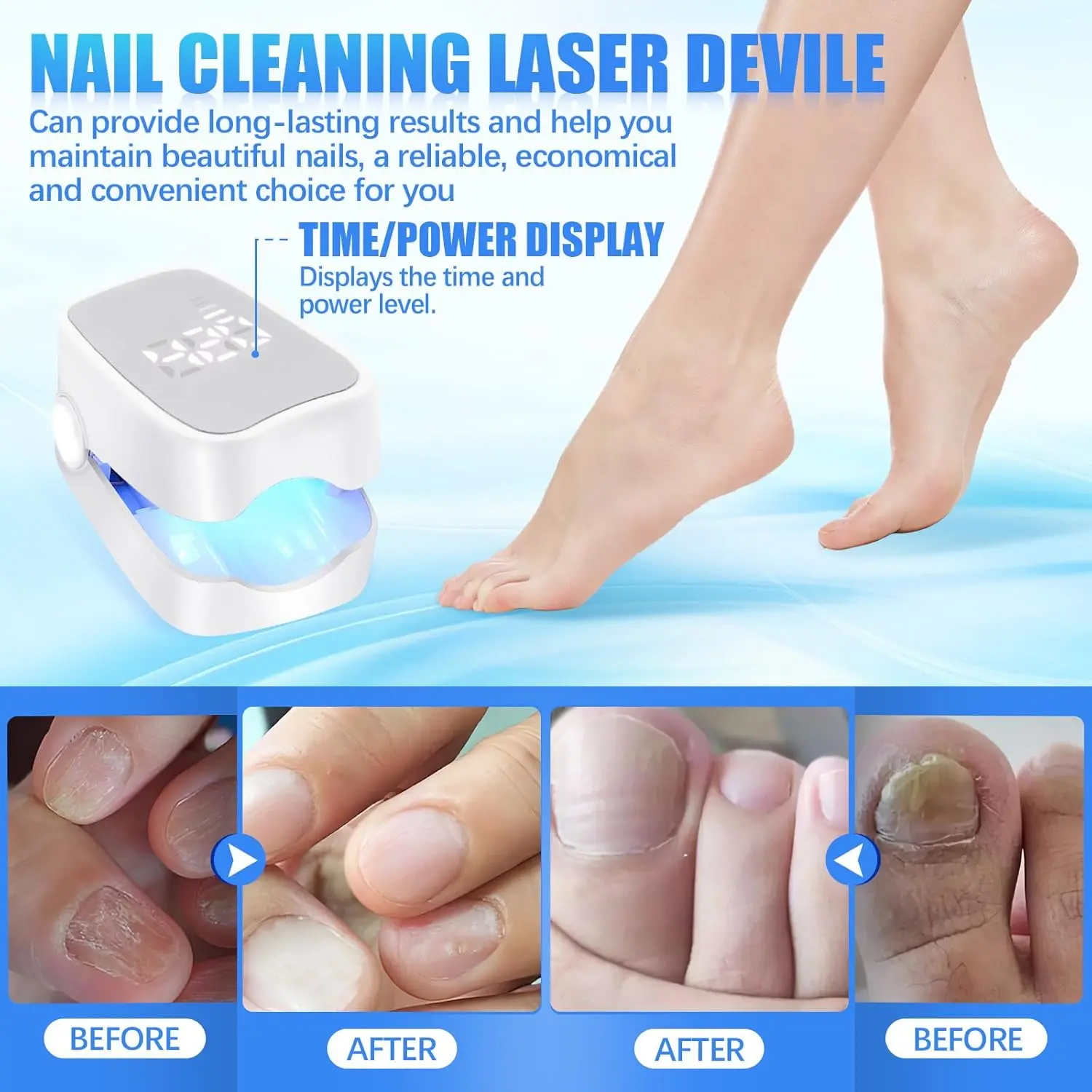 Nail Fungus Treatment LED Laser Device for Cleaning Onychomycosis Digital Display 905nm Infrared Light 470nm Blue LightNailSalon