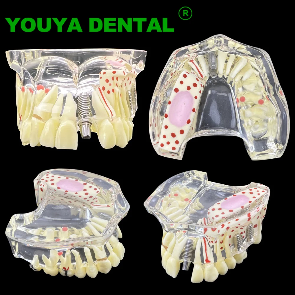 Dental Teeth Implant Model Maxillary Restoration Model With 3 Implants Upper Jaw Typodont Demonstration Model Dentistry Products