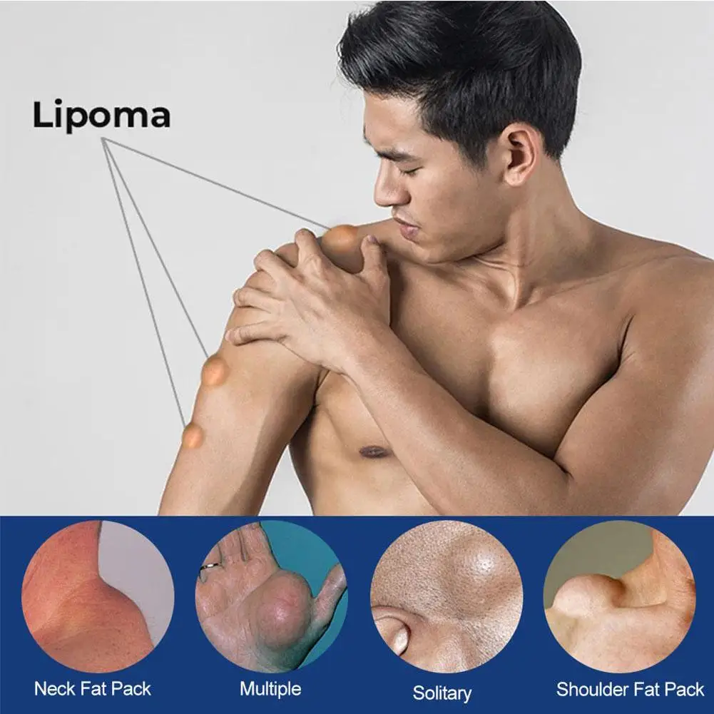 3pcs 20g Lipoma Removal Cream Lipolysis Fat Lump Relief Plaster Skin Swelling Fat Elimination Cream Drop Shipping Health Care