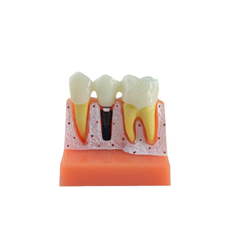 Dental implant model 4x implant solution model, denture restoration dental implants, removable, connecting bridge crowns