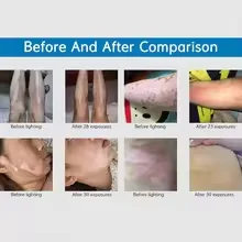 311NM UVB Phototherapy Lamp Device for Vitiligo Treatment UV NarrowBand Ultraviolet Light Therapy Psoriasis Spots