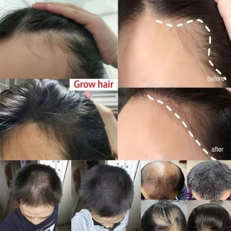 Semprotan Pertumbuhan Rambut Jahe Cepat, Menumbuhkan Akar, Anti Rambut Rontok, Serum Penumbuh Rambut, Perbaikan Kulit Kepala Rusak, Produk Perawatan Menutrisi untuk Wanita dan Pria