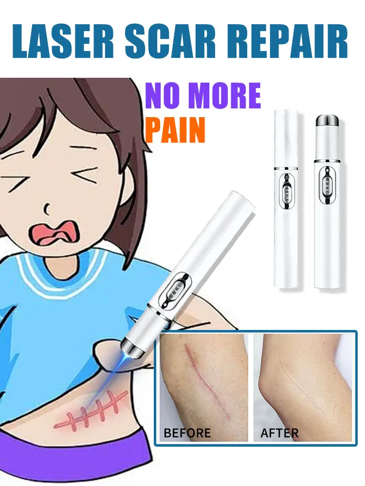 

removal laser scar pen