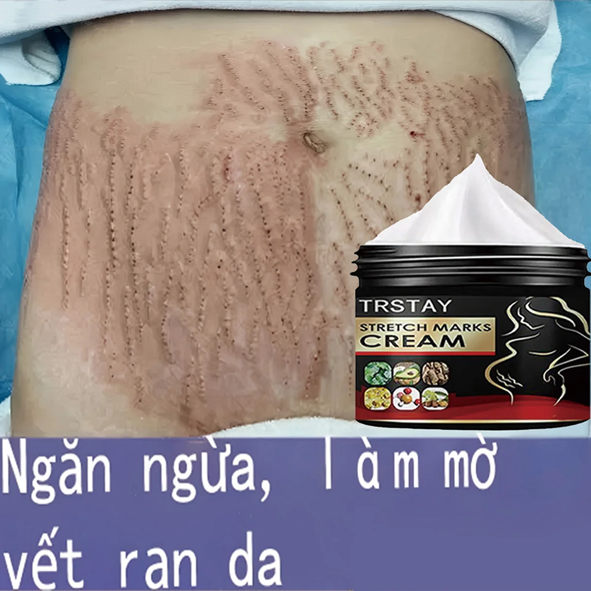 TRSTAY Stretch Mark Cream for Pregnancy Skin Replenish And Repair Cell Growth Promotion Maternity Striae Gravidarum Care