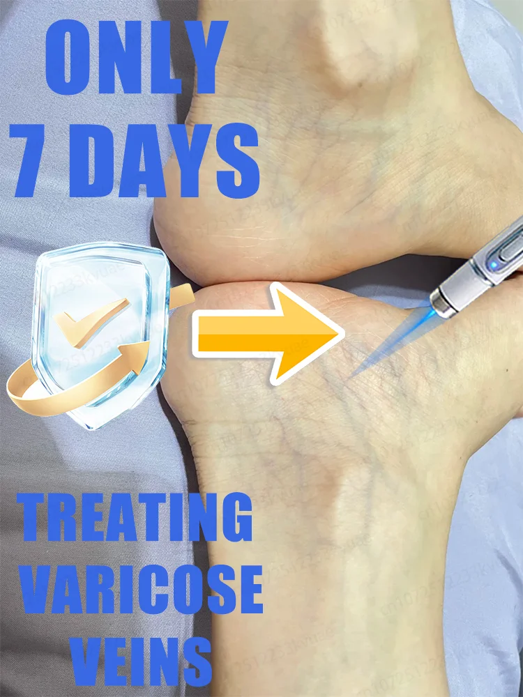

Generation-2 Laser Says Goodbye To Spider Legs Varicose In 7 Days