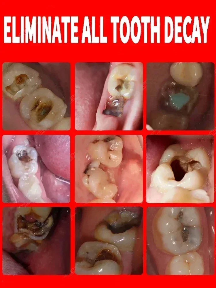 Dissolvant de calcul dentaire, dentifrice blanchissant, élimination des odeurs buccales, prévention de la mauvaise haleine, parodontite, nettoyage dentaire