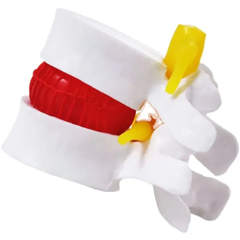 A Demonstration Model Of Human Lumbar Intervertebral Disc Compression Spinal Spinal Skeletal Pathology Teaching Aids