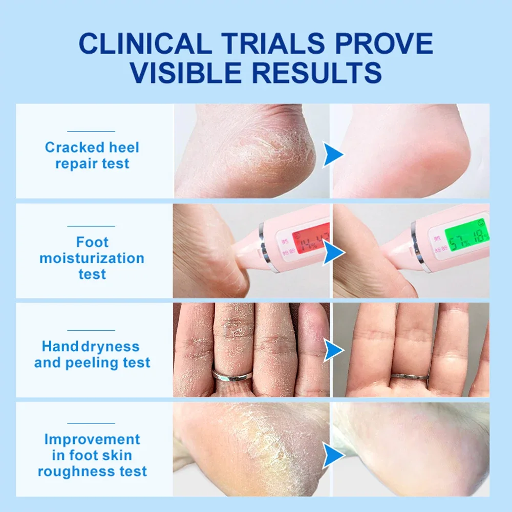 كريم تقشير سريع للقدم ، مزيل الجلد الميت ، كريم إصلاح تشقق الكعب ، علاج مرطب ، العناية ببشرة قدم اليد ، قناع القدم