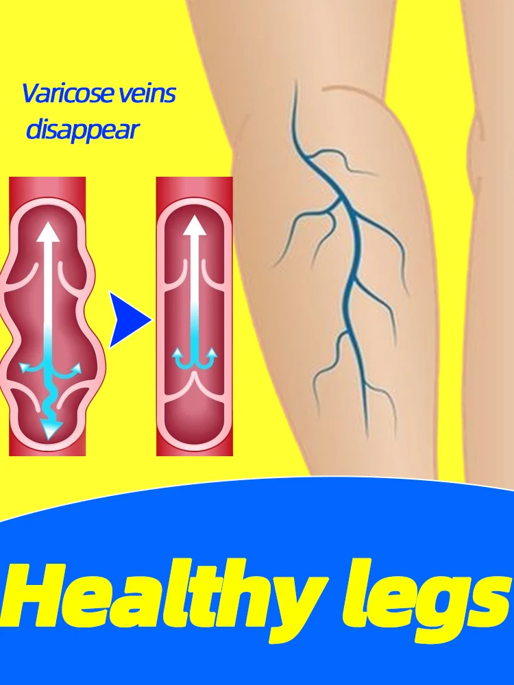 

Varicose Veins Laser