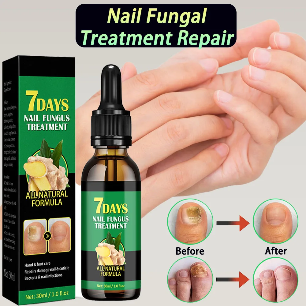 Nail Fungal Treatment Device 7 Days Repair Oil Foot Toe Essence Anti Infection Paronychia Ginger Onychomycosis Gel Care Products