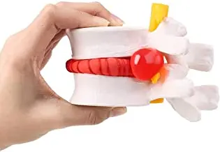 Human Lumbar Disc Herniation Spine Model 1.5X Disc Model Anatomy Vertebral Disc Model School Teaching