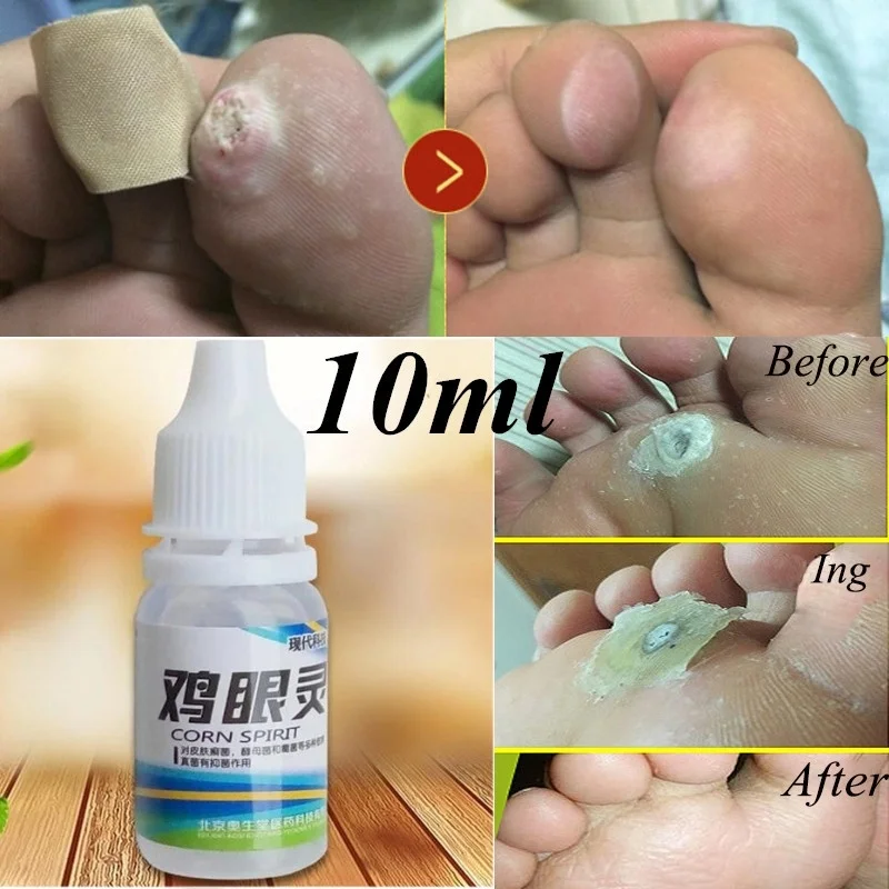 Powerful Foot Corn Remover Useful Foot Callus Remover 10ml Pro